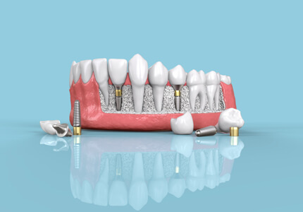 Reasons for Dental Implants